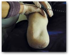 DEEP OSCILLATION applied on amputations  &raquo; Click to zoom ->