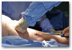 After Liposuction DEEP OSCILLATION with the Evident Aesthetics or Personal Aesthetics minimizes pain, bruising and swelling so the results can be enjoyed much sooner  &raquo; Click to zoom ->
