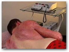 In the treatment of burns DEEP OSCILLATION is applied through special foil  &raquo; Click to zoom ->