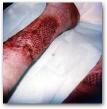 Skin transplantation before Deep Oscillation applied through special foil  &raquo; Click to zoom ->