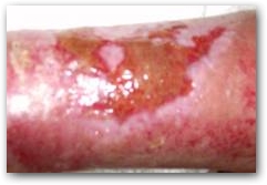 Visit Six: Shows the brownish tinge following treatment with the laser, periphery tissue granulation and shrinkage of the ulcer.  &raquo; Click to zoom ->