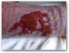 Visit Two: Deep ulcer on the medial aspect of the left calf  &raquo; Click to zoom ->