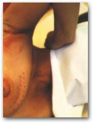 Applicable day one post operative DEEP OSCILLATION aides lymph drainage following breast cancer surgery  &raquo; Click to zoom ->