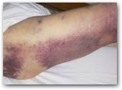 Picture One: Pre DEEP OSCILLATION Haematoma  &raquo; Click to zoom ->