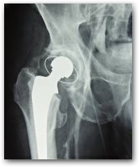 Post Hip Prosthesis patients confirm that  in very effective for pain, mobility and flexibility.  &raquo; Click to zoom ->