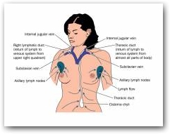 Lymphoedema also known as lymphatic obstruction, is a condition of localized fluid retention and tissue swelling caused by a compromised lymphatic system. The lymphatic system returns the interstitial fluid to the thoracic duct and then to the bloodstream, where it is recirculated back to the tissues. Tissues with lymphoedema are at risk of infection.  &raquo; Click to zoom ->