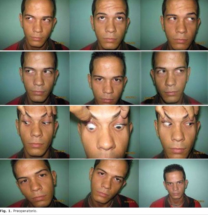 4th Cranial Nerve Palsy Exercises