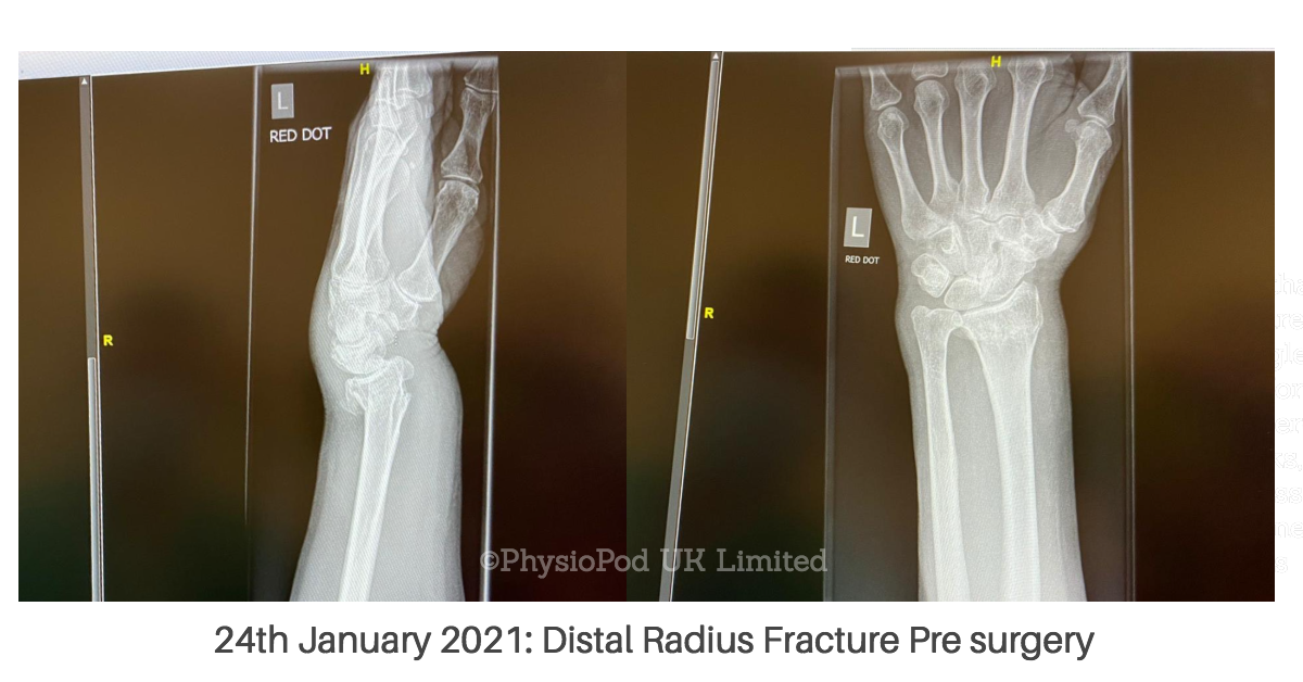 Distal Radius Fracture: Adding Daily Deep Oscillation To The Healing  Process, PhysioPod UK Ltd, Exclusive UK & Ireland Suppliers
