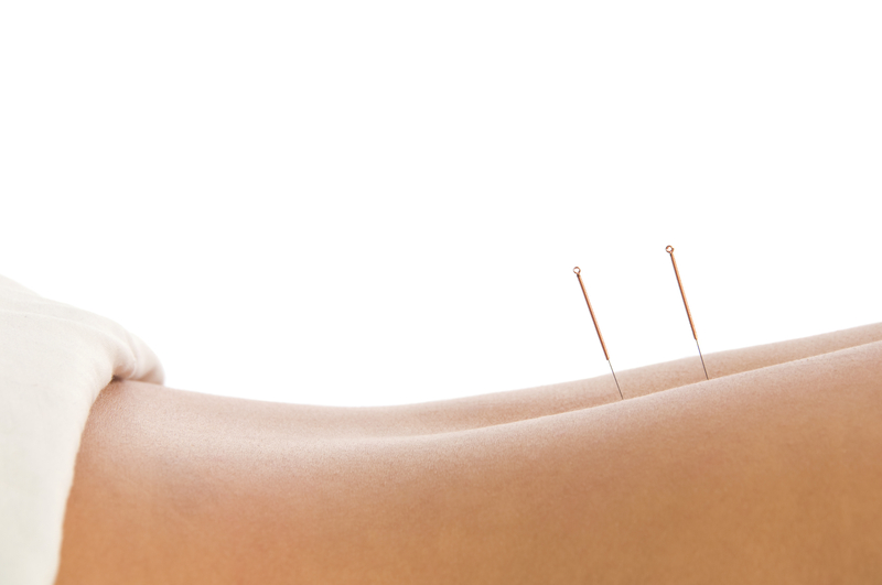 dry needling