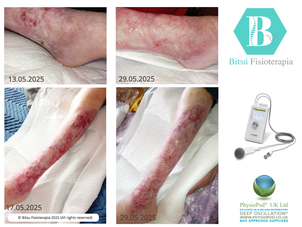 results ulcer healing