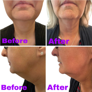 Clinical Case Report: Multimodal Therapy for Severe Head and Neck Lymphoedema and Fibrosis Driven by Deep Oscillation
