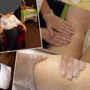 Personal Positive Experience with Deep Oscillation Therapy on The Diagnosis of Lipoedema – Stage 3: Type III