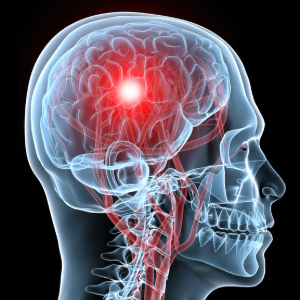 Case Study: Peter, Aged 73 – Resolution of Severe Migraine and Blurred Vision