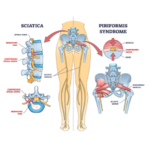 Deep Oscillation Therapy for Piriformis Syndrome and Scarring