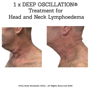 Lisa Capitelli: DEEP OSCILLATION® Brings Rapid Head and Neck Lymphoedema Improvements, Often After Just One Session